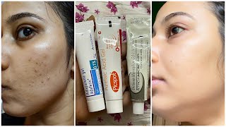 Dermatologist Recommended Best 3 Creams to remove Pimple Marks Acne Scars Dark Spots PIH [upl. by Dulcia]