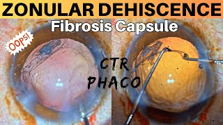 Zonular Dehiscence Noted during Phacoemulsification Management strategies  Dr Deepak Megur [upl. by Ahcas]