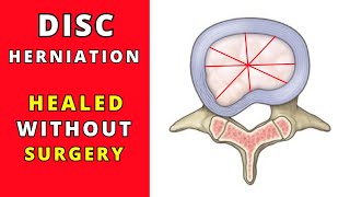 L5 S1 Disc Herniation Recovery without surgery [upl. by Adnavoj]