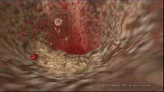 MEDICAL  How cholesterol clogs your arteries atherosclerosis [upl. by Yanttirb]