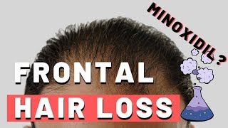 Frontal Hair Loss  Does Minoxidil Work [upl. by Sturges]