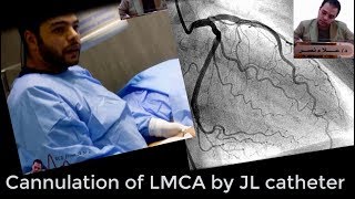 Left coronary system angiographic cannulation by JL catheterDr Alaa Nasr2019 [upl. by Boesch510]