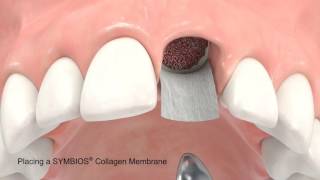 SYMBIOS Socket Preservation For Delayed Implant Placement [upl. by Fortune]