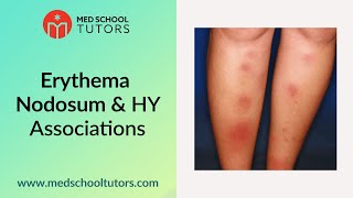 Erythema Nodosum amp High Yield Associations for the USMLE Step 1 [upl. by Scharf]