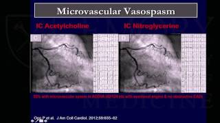 Emory Cardiology Grand Rounds 05012017 [upl. by Ahsenyl]