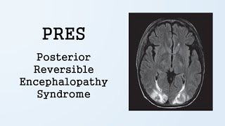 PRES Posterior Reversible Encephalopathy Syndrome [upl. by Lessirg]