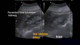 Persistent fetal lobulation kidney ultrasound video [upl. by Ariday]