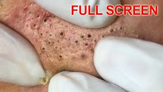 Blackheads removal  Best Pimple Popping Videos [upl. by Botzow]