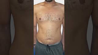 Type 4 Gynecomastia Surgery by plastic surgeon  before and after [upl. by Jelsma]