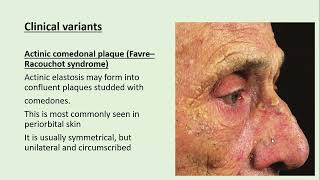 Lecture147 Acquired disorders of Dermal Connective Tissues Rooks Chapter 96 [upl. by Florie]