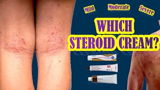 Which Steroid Cream Works Best For Eczema  Mild Moderate Severe Eczema Treatment [upl. by Edobalo]