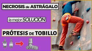 💪 NECROSIS de ASTRAGALO La mejor SOLUCIÓN una PRÓTESIS de TOBILLO [upl. by Ahselyt561]