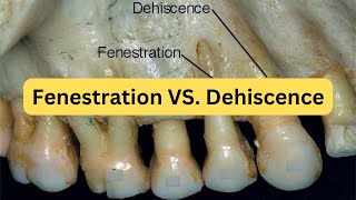 Difference between fenestration and dehiscence with mnemonic [upl. by Yedorb758]