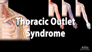 Thoracic Outlet Syndrome TOS Animation [upl. by Akienom]