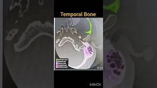 CT temporal Bone anatomy mastoid temporalbone [upl. by Armalla21]