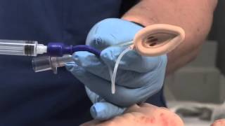 Laryngeal Mask Airway Placement [upl. by Sirehc]