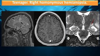 Teenager Homonymous hemianopsia [upl. by Hanas750]