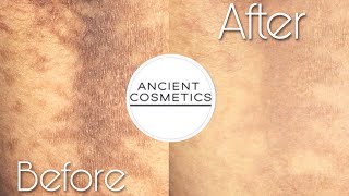 CLEARER SKIN AFTER 1 USE‼️ Ancient Cosmetics Update✨ CONFLUENT amp RETICULATED PAPILLOMATOSIS CURE😩 [upl. by Adnilema]