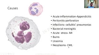 Neutrophilia  GAME 44  Pathology practical slides  MBBS  SRM  Dr GSS  University questions [upl. by Orlena143]