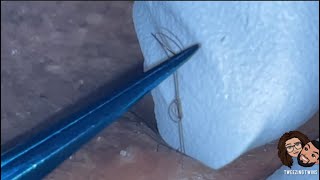 Ingrown Hair Removal Ep28 [upl. by Shaddock395]