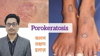 Porokeratosis का कारण लक्षण और इलाज़  Porokeratosis और cancer porokeratosis skincancer cancer [upl. by Middle]