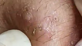 Blackheads amp Whiteheads Satisfying Removal 0075 [upl. by Ansell91]