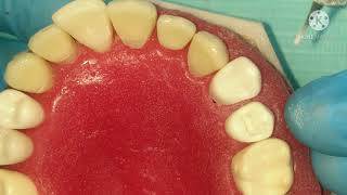 class 1 cavity preparation for amalgam restoration part 2premolars  عربي [upl. by Arammat]