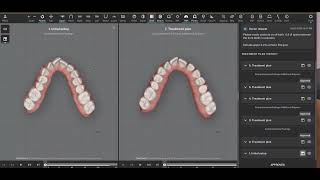 Palate Expansion Case 7 [upl. by Naid]