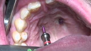 OrthoEasy  Insertion palatinal in maxilla [upl. by Suivat]