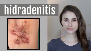 HIDRADENITIS SUPPURATIVA QampA WITH DERMATOLOGIST DR DRAY [upl. by Bearce]