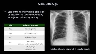 How to Interpret a Chest XRay Lesson 8  Focal Lung Processes [upl. by Ahsieat]