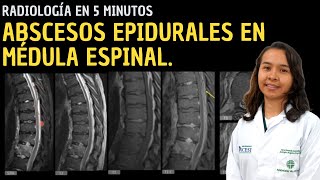 Radiología en 5 minutos Abscesos epidurales en médula espinal [upl. by Lianne]