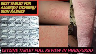 BEST TABLET FOR ALLERGY AND SKIN RASHES AND ITCHINGCETZINE TABLET FULL REVIEW IN HINDIURDU [upl. by Nevram]