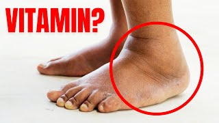 1 Vitamin to Eliminate Swelling in Feet and Legs [upl. by Borreri452]