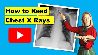 How to read chest X rays RIPEAI [upl. by Akirea189]