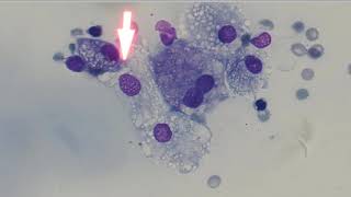 5 Minute Rounds Salivary mucocele ranula [upl. by Eybba283]