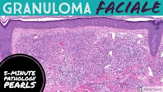 Granuloma Faciale 5Minute Pathology Pearls [upl. by Sankaran]