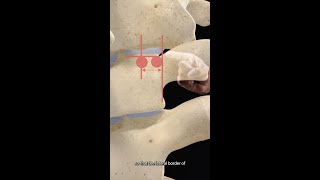 Optimal Placement for Thoracic Pedicle Screws Shorts [upl. by Marcello]