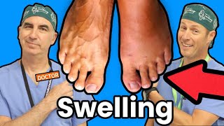 Foot and Ankle Swelling What Causes It [upl. by Iliam]