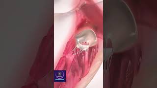 Mitral Valve Anatomy 3D Animation shorts [upl. by Burman]