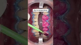 ¿Ya conocías esto del blanqueamiento dental 🦷 [upl. by Anelat]