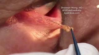 Excision of eyelid papilloma 91216 Shannon Wong MD [upl. by Ayerim]