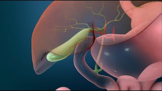 Surgery to Remove Your Gallbladder Open Cholecystectomy [upl. by Gerek]