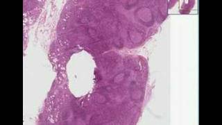 Histopathology Lymph nodeToxoplasmosis [upl. by Shayna]