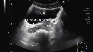 Ultrasound Video showing an enlarged seminal vesicles with UTI [upl. by Nero]