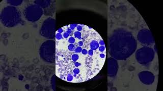 Differential Count with Atypical cells seen  Pleural Fluid Analysis [upl. by Annirac804]