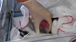 Capillary sampling on neonates for blood gas analysis [upl. by Dnalerb]