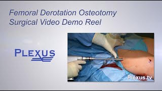 Bilateral Femoral Derotational Osteotomies Surgical Video [upl. by Yentnuoc374]