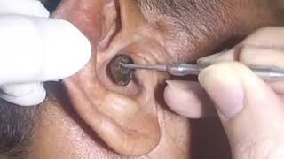 Removing MASSIVE Earwax from Mans Ear [upl. by Ahsimit]