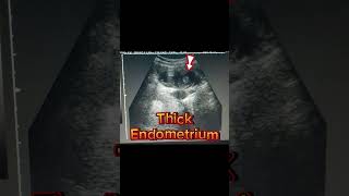 Hemorrhagic Cyst  Ovarian cyst  internal Echoes Haemorrhagic on Ultrasound [upl. by Ednalrym293]